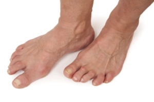 Recognizing Rheumatoid Arthritis Symptoms in the Feet