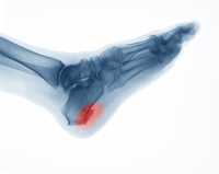 Causes and Risks of Heel Spurs
