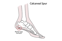 Symptoms and Risk Factors of a Heel Spur