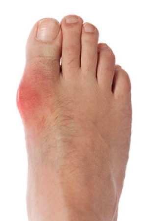 Treating Gout