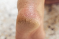 What Causes Cracked Heels?