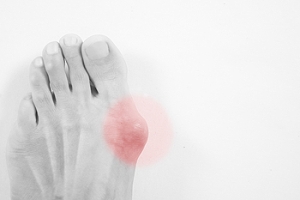 Where Is a Bunion Located?