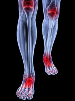 Can You Get Osteoarthritis in Your Toe?