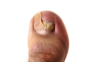 Common Causes of Split Toenails