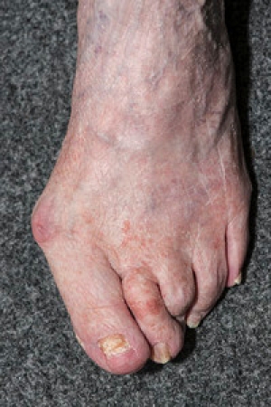 Preventing Bunion Development