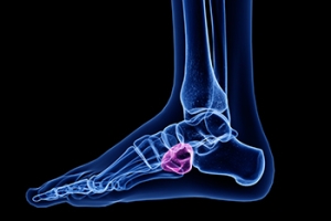 Certain People May Be Prone to Getting Cuboid Syndrome