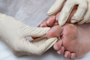 Symptoms of Diabetic Feet