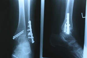 Common Types of Fractures on the Outside of the Foot