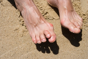 Treatment for Hammertoe
