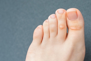 Causes of Corns and How to Ease the Pressure
